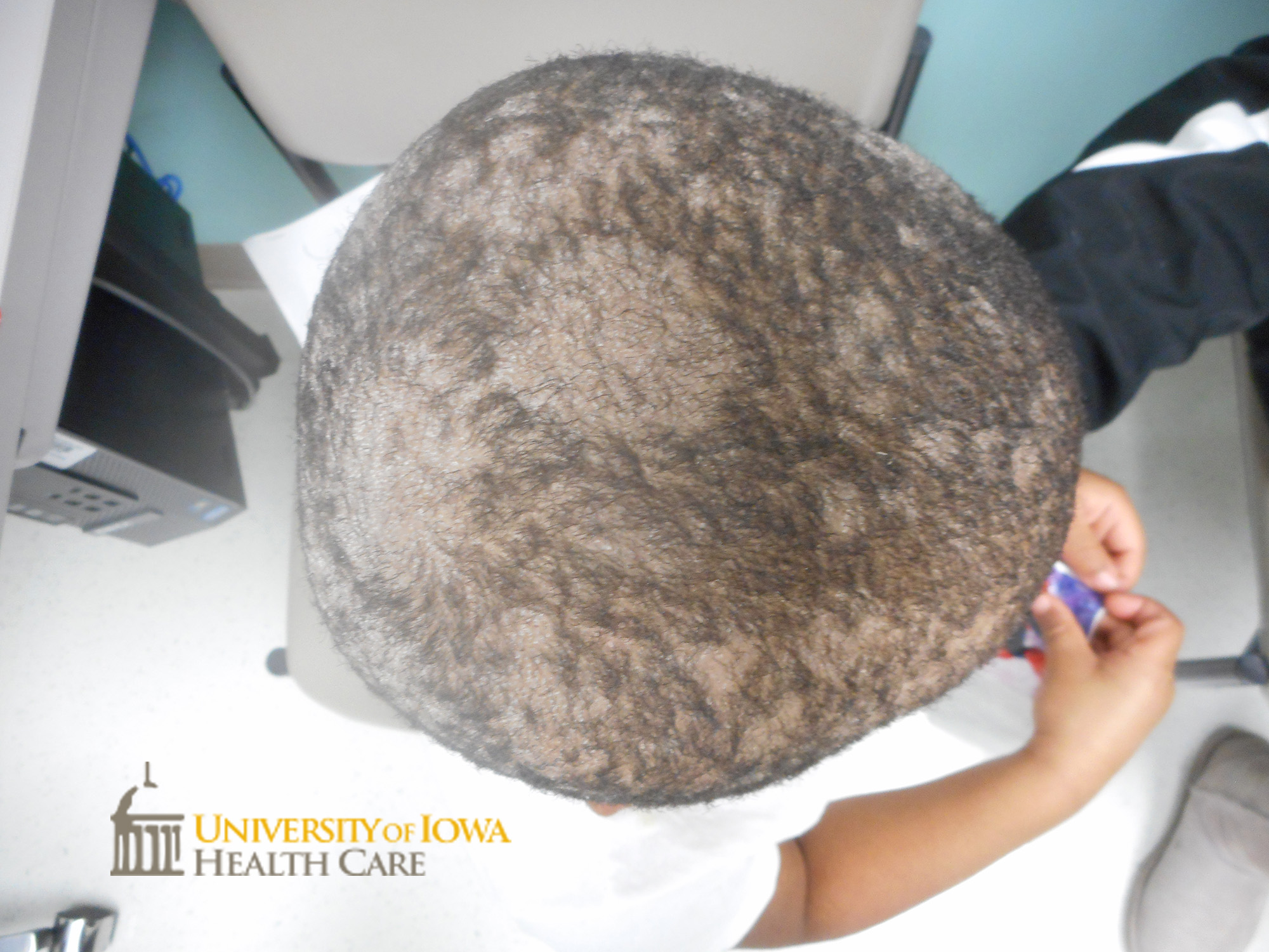 Crusted alopetic patches and surounding scaling on the scalp. (click images for higher resolution).